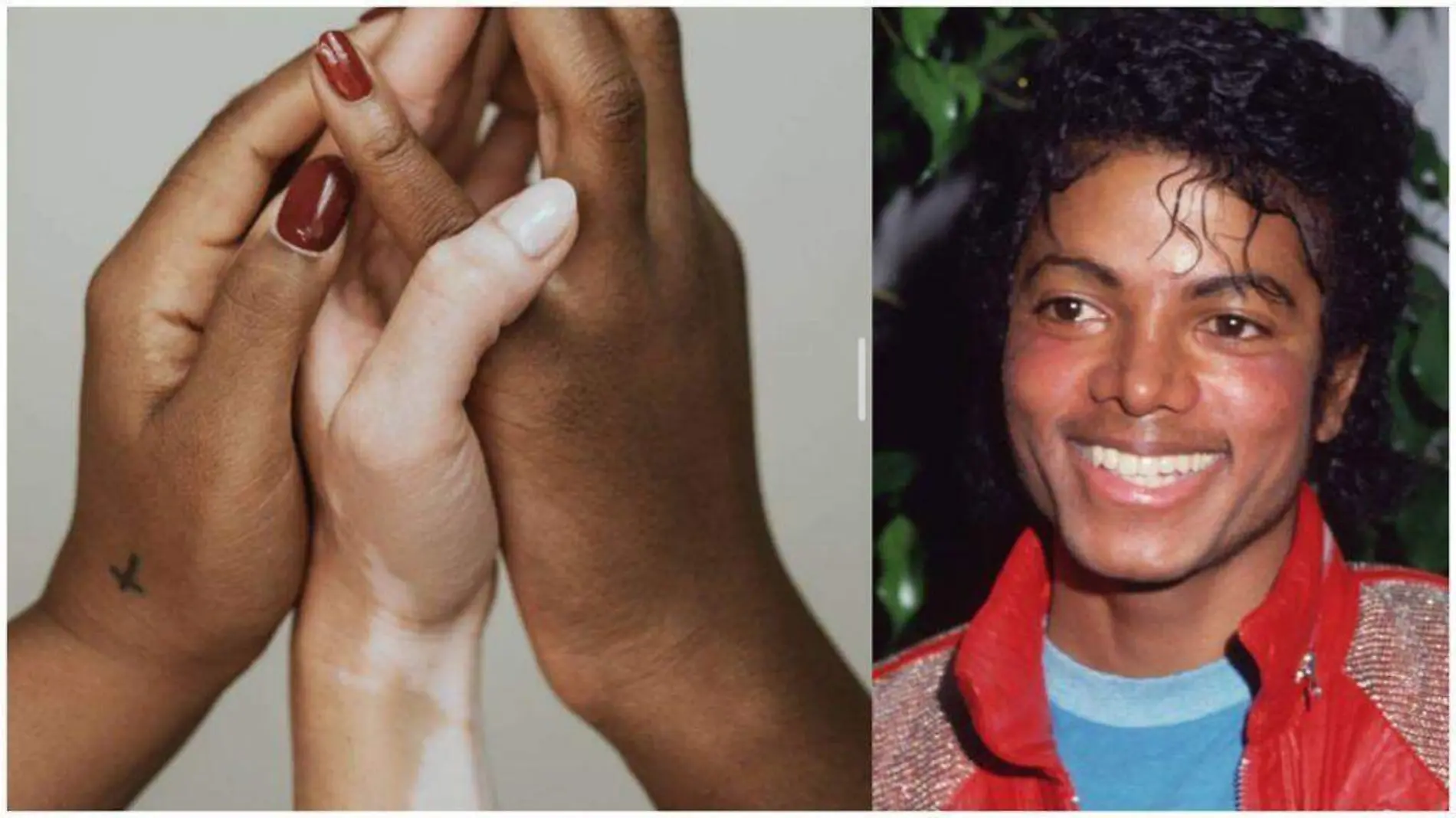 Dia mundial del vitiligo, los famosos que padecen esta enfermedad